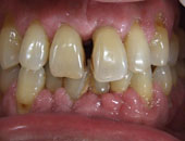 歯周病治療 治療前