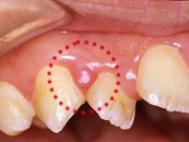 歯肉マッサージ 治療前