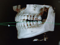 歯科用ＣＴ　プレビスタ