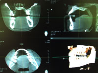 歯科用ＣＴ　プレビスタ