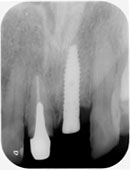 レントゲン インプラント埋入後