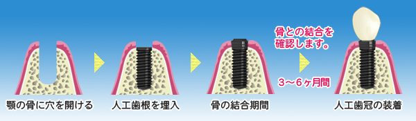 インプラント１回法