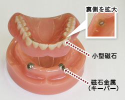 磁性アタッチメント義歯